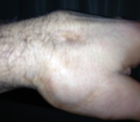 Витор Белфорт сломал руку